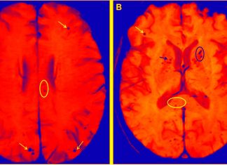 APOE4 allele gene more than doubles risk of severe COVID-19 and cerebral microhemorrhages