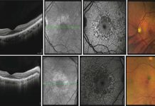 New potential treatments for late-onset retinal degeneration (L-ORD)