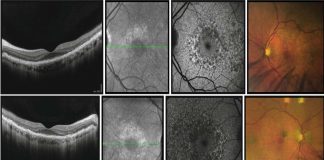 New potential treatments for late-onset retinal degeneration (L-ORD)