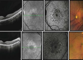New potential treatments for late-onset retinal degeneration (L-ORD)