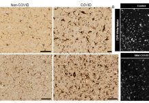 Mild respiratory SARS-CoV-2 infection can cause multi-lineage cellular dysregulation and myelin loss in the brain