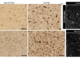 Mild respiratory SARS-CoV-2 infection can cause multi-lineage cellular dysregulation and myelin loss in the brain