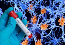 Multiple sclerosis (MS) is likely caused by infection with the Epstein-Barr virus (EBV)