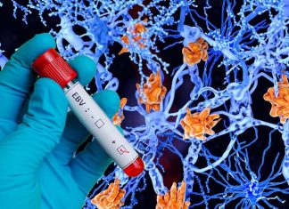 Multiple sclerosis (MS) is likely caused by infection with the Epstein-Barr virus (EBV)