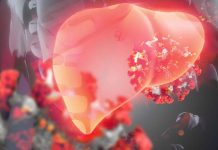 Understanding the Connection Between Metabolic Dysfunction-Associated Steatotic Liver Disease (MASLD) and Increased Susceptibility to SARS-CoV-2 Infection