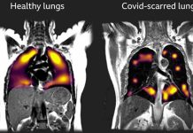 SARS-CoV-2 Causes Prolonged Change To Airway Immune Landscape With Evidence Of Cell Death Due To Ongoing Activation Of Cytotoxic T Cells