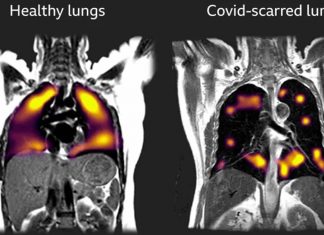 SARS-CoV-2 Causes Prolonged Change To Airway Immune Landscape With Evidence Of Cell Death Due To Ongoing Activation Of Cytotoxic T Cells