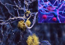 U.S Department Of Defense Study Finds That COVID-19 Infected Individuals Younger Than 60 Years Are Developing Beta-Amyloid Deposits