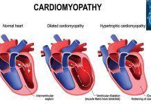 Researchers have found a way to treat dilated cardiomyopathy (DCM)