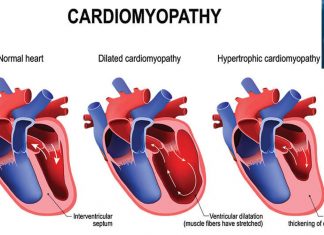 Researchers have found a way to treat dilated cardiomyopathy (DCM)