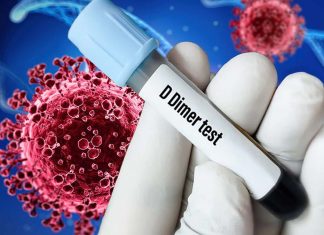 D-dimer levels can predict disease outcome in hospitalized patients with COVID-19