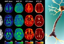 Anxiety and post traumatic stress disorder (PTSD) increase myelin in brain’s gray matter