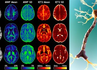 Anxiety and post traumatic stress disorder (PTSD) increase myelin in brain’s gray matter