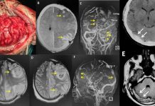 Omicron / mRNA Vaccine : Increasing Incidences Of Cerebral Venous Sinus Thrombosis (CVST)