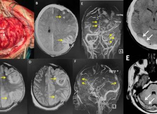 Omicron / mRNA Vaccine : Increasing Incidences Of Cerebral Venous Sinus Thrombosis (CVST)