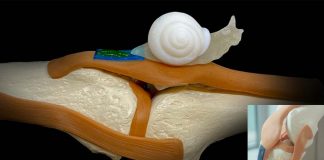 New biomaterial-based tendon therapy that addresses key challenges in the regeneration process