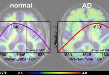 A new blood test has proven highly accurate in detecting early signs of Alzheimer’s disease