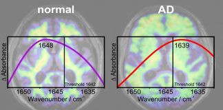 A new blood test has proven highly accurate in detecting early signs of Alzheimer’s disease