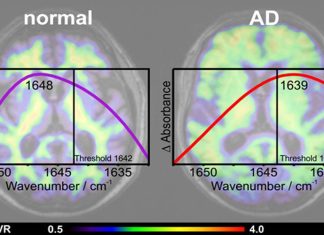 A new blood test has proven highly accurate in detecting early signs of Alzheimer’s disease
