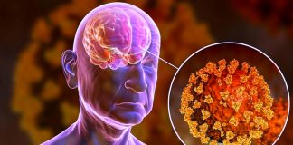 One-third of patients with COVID-19 develop neurological symptoms
