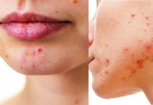 Cathelicidin’s role in Acne treatment