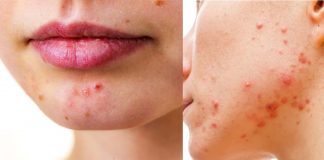 Cathelicidin’s role in Acne treatment