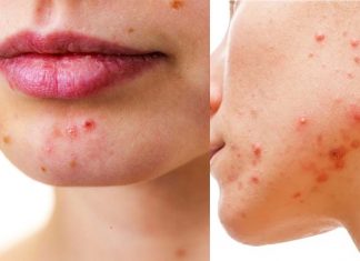 Cathelicidin’s role in Acne treatment