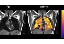 Long COVID Patients Have Impaired Gas Transfer In Lungs Which Cannot Be Detected By Normal CT Scans