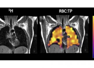 Long COVID Patients Have Impaired Gas Transfer In Lungs Which Cannot Be Detected By Normal CT Scans