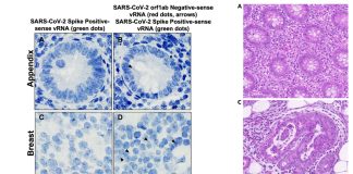 Long COVID-19: Persistence of residual SARS-CoV-2 viral antigen and RNA in tissues of patients