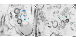 I ricercatori hanno scoperto che il tropismo testicolare SARS-CoV-2 è più alto di quanto si pensasse