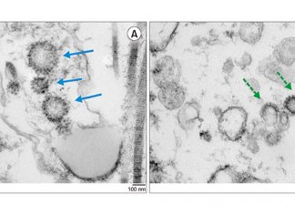 I ricercatori hanno scoperto che il tropismo testicolare SARS-CoV-2 è più alto di quanto si pensasse