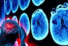 L’infiammazione innescata da SARS-CoV-2 porta a un aumento del danno neurotossico nelle aree corticali del cervello umano