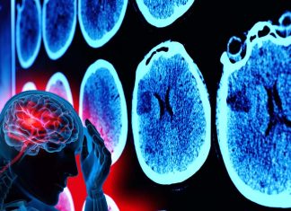 L’infiammazione innescata da SARS-CoV-2 porta a un aumento del danno neurotossico nelle aree corticali del cervello umano