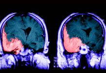Hormonal treatments with drug cyproterone acetate (CPA) are associated with increased risk of benign brain tumor