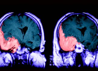 Hormonal treatments with drug cyproterone acetate (CPA) are associated with increased risk of benign brain tumor