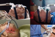 Continuous positive airway pressure (CPAP) treatment may not be effective in patients older than 80