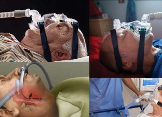 Continuous positive airway pressure (CPAP) treatment may not be effective in patients older than 80