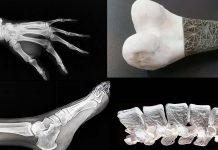 Gallium used in new bone implants significantly reduces failure rates