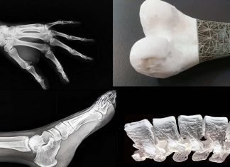 Gallium used in new bone implants significantly reduces failure rates