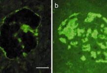 Type 2 diabetes: identify the step-by-step changes that take place in hIAPP as it changes into amyloid