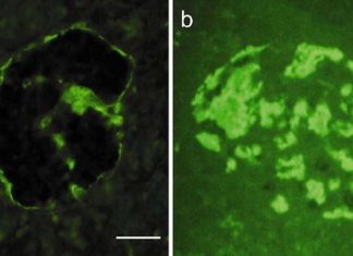 Type 2 diabetes: identify the step-by-step changes that take place in hIAPP as it changes into amyloid