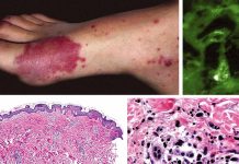 Association between immunoglobulin A (IgA) vasculitis and coronavirus disease 2019 (COVID-19) in children
