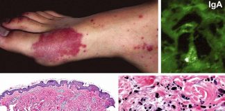 Association between immunoglobulin A (IgA) vasculitis and coronavirus disease 2019 (COVID-19) in children