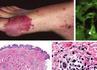 Association between immunoglobulin A (IgA) vasculitis and coronavirus disease 2019 (COVID-19) in children