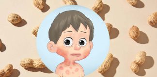 Two new treatments can induce peanut allergy remission in children