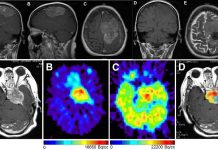 High-grade meningiomas: Immune checkpoint inhibitors can slow disease progression and offer hope for longer survival