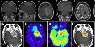 High-grade meningiomas: Immune checkpoint inhibitors can slow disease progression and offer hope for longer survival