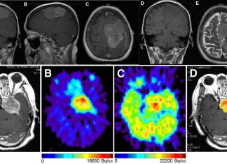 High-grade meningiomas: Immune checkpoint inhibitors can slow disease progression and offer hope for longer survival