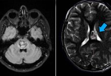A cavernous angioma affects more than one million Americans and carries a lifetime risk of stroke and seizures